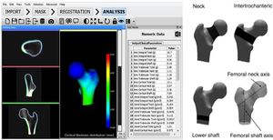 DXA-3D software interface (left) and regions of interest used in calculation of the DXA-3D structural parameters (right). BMC: bone mineral content; DXA: dual-energy X-ray absorptiometry; vBMD: volumetric bone mineral density; 3D: three-dimensional. Reproduced from Clotet et al.19