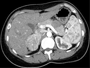 Abdominal CT scan in arterial phase showing an enhanced-uptake right adrenal mass measuring 6×4cm in size, with numerous internal blood vessels.