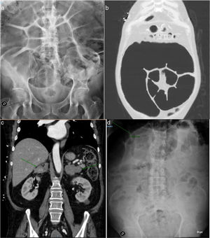 a) Plain abdominal X-ray view. Large left colon distension with a maximum diameter of 11.2 cm. b) CAT scan of the chest and abdomen. Large sigmoid colon dilatation. c) CAT scan of the chest and abdomen. Greatly enlarged adrenal glands of hyperplastic appearance. d) Plain abdominal X-ray view. Colon calibre reduction to 7.8 cm following bilateral adrenalectomy.