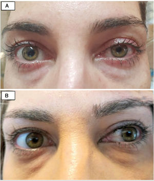 (A) Day five after thyroid surgery, with right mydriasis and ipsilateral upper eyelid retraction. (B) Follow-up two months after thyroid surgery, with complete resolution of the condition.