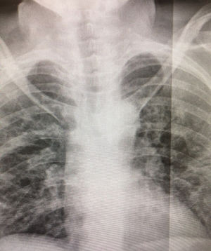 AP chest X-ray with bilateral infiltrates suggestive of COVID-19.