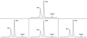 Haemoglobin electrophoresis. Above, result for the first case in 2018, interpreted as haemoglobin J (Hb J). Below, results for the second case interpreted in 2015 as possible haemoglobin Shepherds Bush (left), in 2016 as possible haemoglobin Andrew-Minneapolis (centre) and in 2018 as possible haemoglobin Fannin-Lubbok (right). Under normal conditions, there is no haemoglobin J peak and more than 95% corresponds to haemoglobin A (Hb A). Haemoglobin A2 (Hb A2) was normal in all cases.