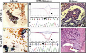 Cytology image, HRM, sequence and histology. Above. Example of a cytological smear of an AUS/FLUS category indeterminate follicular proliferation (A) that was positive for the BRAF V600E mutation indicated by the arrow on the HRM curve (B) confirmed by Sanger sequencing (C). Then, the histology in D indicates that it is an invasive non-encapsulated follicular variant of papillary thyroid carcinoma. Below. Example of cytology of a nodule diagnosed as suspicious for follicular neoplasm (E) with the presence of the NRAS-Ex3 mutation detected by HRM (F) and confirmed by Sanger sequencing (G). Histology H indicates that it is a minimally invasive encapsulated follicular thyroid carcinoma. A and E correspond to cytology stained with the Papanicolaou technique. Biopsies D and H are stained with haematoxylin-eosin. The black arrows indicate the curve of the positive sample plus the positive control. Asterisks in black indicate the base change associated with the mutation.