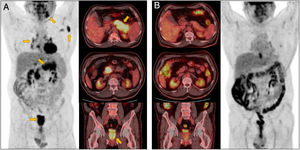 (A) Axial and coronal PET-CT images revealing involvement of multiple organs: left submandibular gland, axillary and mediastinal lymphadenopathy, pancreas, and prostate. (B) Control PET-CT images after two cycles of treatment with rituximab and prednisone demonstrated a complete metabolic response in all previously affected locations.