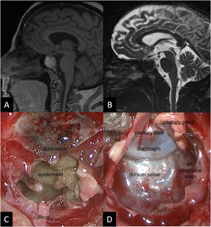 A) MRI T1 sequence. Well-delimited 2-cm intrasellar mass of insufflated appearance, heterogeneously hyperintense in T1, with nodular gadolinium uptake in dynamic sequences in the anterosuperior third of the lesion. B) MRI T2 sequence. The lesion is hypointense, does not compress the optic tract and extends the sella turcica, occupying part of the sphenoid sinus. C) Intra-operative image showing the squamous appearance of the tumour, with little vascularisation and a slight yellowish colour due to its keratin content. D) Intra-operative image after resection showing the sellar floor and dorsum sellae and the walls of both cavernous sinuses, now free of tumour. Above this can be seen the intact diaphragm and the remainder of the compressed pituitary gland and pituitary stalk in the upper left.