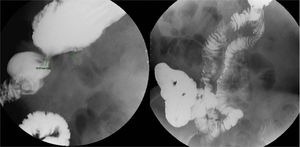 Transit study of the oesophagus, stomach and small bowel with barium, belonging to Case 1. The first image shows anastomotic stenosis measuring 10 mm in diameter. The second image shows a long retrograde loop that filled with contrast.
