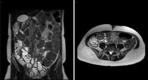 Intravenous contrast-enhanced MRI of the abdomen, performed in Case 3. Jejunojejunal intussusception is seen in the empty right side and jejunoileal intussusception is seen in the empty right iliac fossa and hypogastrium, with no evidence of obstruction and with a redundant sigmoid colon and abundant gas and faecal content in the left half of the colon. All this was consistent with malabsorption.