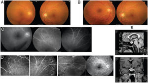 Retinographies, fluorescein angiography and pituitary magnetic resonance imaging. A) Initial retinography showing vitreous haemorrhage. B) Follow-up retinography. C) Initial fluorescein angiography: superior temporal retinal arcade of the RE with vascular abnormality (venous stenosis and prominent vascular loops) on the periphery. No neovessels and no areas of vascular ischaemia. D) Follow-up fluorescein angiography showing laser scars and no neovessels. E) Pituitary magnetic resonance imaging: a pituitary adenoma measuring 14 mm x 20 mm x 14 mm that displaced the pituitary stalk to the right, compressed the pituitary gland, caused bulging of the diaphragma sellae and extended to the left cavernous sinus (Knosp grade 2). No compromise of the optic chiasm.