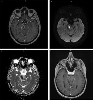 MRI shows a brainstem lesion. (A) Axial post-contrast T1-weighted MR image shows a right midbrain lesion with circumferential enhancement. (B) Axial diffusion MR image shows a high-signal-intensity area. (C) Axial diffusion with apparent diffusion coefficient (ADC) MR image shows a low-signal-intensity area. (D) Axial post-contrast T1-weighted MR image after 6 months showing a small residual hypointense sequela of the midbrain without contrast enhancement that correlated with the effectiveness of the antibiotic treatment.