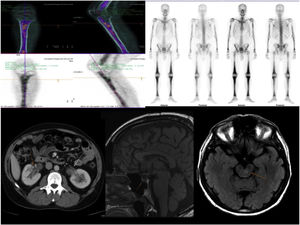 Radiological findings: Characteristic bone involvement on PET/CT and bone scintigraphy, CT of the abdomen with no pathological findings in the kidney; MRI of the brain. Sagittal slices in T1 and axial slices enhanced in T2 FLAIR. The sellar region shows no significant pathological abnormalities. Multiple hyperintense signal abnormalities are identified on T2 FLAIR in the brain stem, especially in the area of the pons.