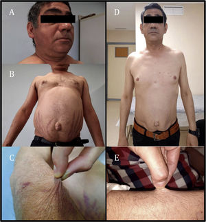 (A and B) Cushing's syndrome at diagnosis. (C) Skin atrophy. (D and E) Resolution of signs and symptoms following suspension of cobicistat and fluticasone.