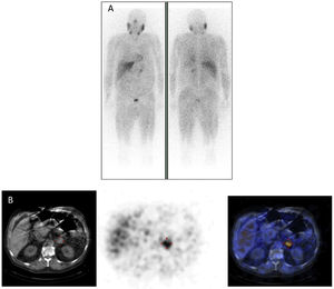 Left pheochromocytoma on 123I-MIBG scintigraphy.