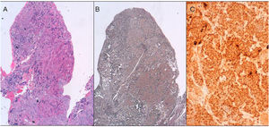 Photomicrographs of samples of corticotroph hyperplasia. (A) H.E stain, 4×. Expanded acini with homogenous eosinophilic cells. (B) Expanded reticulin network, 4×. (C) ACTH immunostaining, 40×. H.E: haematoxilin–eosin.