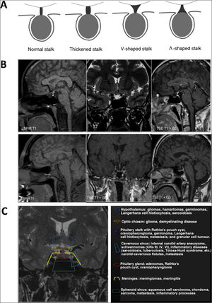 Morphological alterations. A) Stalk morphologies. B) Upper panels: ectopic neurohypophysis and hypoplasia of the stalk and adenohypophysis; lower left panel: diabetes insipidus (absence of normal hypersignal on T1 of the neurohypophysis). Lower centre and right panels: empty sella turcica (coronal and sagittal section). C) Classification of sellar and parasellar lesions according to their origin.