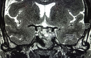 Measurement of the region of interest (ROI) in the solid portion of the adenoma, white matter and grey matter of the temporal lobe. In this case, it would be a hypointense pituitary NET on T2. Avg: average; Dev: standard deviation; Perim: perimeter.