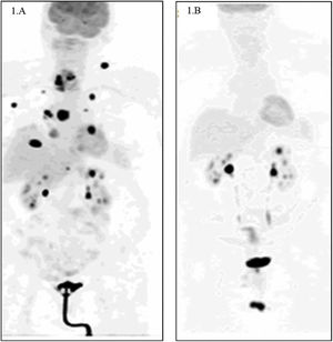 A) 18F-fluorodeoxyglucose positron emission tomography (FDG PET) on diagnosis. A right cervical mass with increased metabolic activity with an SUVmax of 28.5 and images suggestive of multiple bilateral pulmonary, lymph node (in the right supraclavicular and left axillary area), muscular and right atrium metastases. B) FDG PET after 11 months of treatment with BRAF/MEK inhibitors (dabrafenib-trametinib). Morpho-metabolic involution of the right cervical mass with disappearance of the metastatic lesions at all levels is observed.