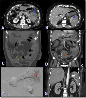 Images A and B show CT slices in the axial plane where dense fluid collections can be seen in relation to the pancreatic and splenic parenchyma, compatible with acute parenchymal haematomas (blue arrows). In images C and D, marked with orange arrows, signs of active bleeding can be seen, consistent with extravascular linear dense images, compatible with contrast extravasation. Images F and G show, respectively, the therapeutic arteriogram for control of the active bleeding (the red arrow indicates points of active bleeding) and the outcome by CT in the coronal plane with metallic embolisation material in the left hypochondrium.