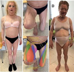 (A) Index case. A 50-year-old woman with a singular phenotype characterised by an absence of subcutaneous adipose tissue in the hips and limbs, an accumulation of fat in the face, neck and axillae and marked muscle hypertrophy. (B) Lower limbs of the index case showing the striking musculature of the thighs. (C) The same photo as panel B in which the different muscles of the thighs have been coloured and identified (arrows). (D) Mother of the index case, 72 years old, with a similar phenotype. Both patients are carriers of the variant c.1396A>G (p.Asn466Asp) in the LMNA gene, which is diagnostic of type 2 familial partial lipodystrophy.