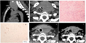 At hospital admission, a chest CT scan revealed an exuberant diving goitre (a) with noticeable tracheal lumen reduction to 3mm×10mm (b). The histopathologic report described thyroid tissue and surrounding soft tissues with infiltration by spindle cell proliferation, in a stroma with large collagen fibres and moderate lymphoplasmacytic inflammatory infiltrate; spindle cells have little nuclear pleomorphism and no mitoses are observed (c, d). After 4 months of follow-up endotracheal prosthesis still provided airway safety (e). After 10 months of prednisolone treatment, thyroid size reduction allowed tracheal prosthesis to be safely removed (f).