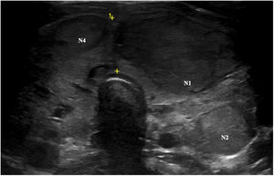 The patient's thyroid ultrasound scan. In this cross section, N1, N2 and N4 can be seen.