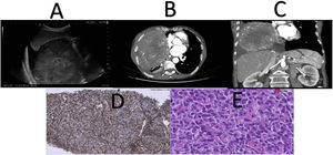 (A) Ultrasound of the abdomen showing a heterogeneous mass attached to the right pleura. (B–C) CT scan of the abdomen with intravenous contrast with axial and coronal slices of the lesion. (D) Tumour cells with nuclear positivity for STAT6. E) Presence of dilated and branched vessels in “staghorn” pattern.