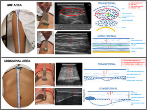 Transversal and longitudinal section of the QRF muscle and the abdominal area. Representation of the anatomical measurement area. Position of the ultrasound transducer. Image and scheme of the anatomical structures.