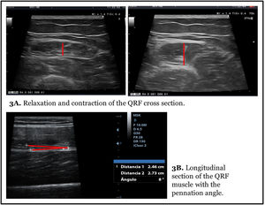 Functional muscle measures. (A) Changes in the shape of the muscle in contraction and relaxation with the measurement of the Y-axis. (B) Pennation angle measurements of the QRF in longitudinal section.