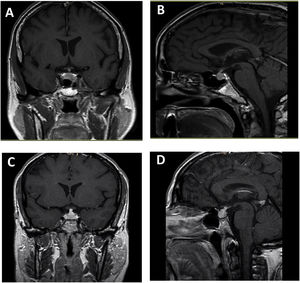 Ipilimumab-induced hypophysitis. Pituitary MRI with coronal T1 (A) and sagittal T1 (B) sequence with paramagnetic contrast in a 59-year-old man with uveal melanoma with liver metastases who developed ipilimumab-induced hypophysitis. Coronal T1 (C) and sagittal T1 (D) pituitary MRI with paramagnetic contrast in a 46-year-old woman with uveal melanoma who developed ipilimumab-induced hypophysitis.