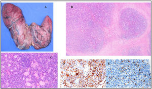 Macroscopic and histological imaging of total thyroidectomy specimen. (A) Macroscopic image of thyroid gland, anterior face, weighing 182g. (B) Histological image of pseudonodular areas due to fibrosis (haematoxylin and eosin, 40×). (C) Immunohistochemistry image with IgG (400×). (D) Immunohistochemistry image with IgG4 (400×).