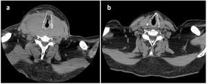 Neck computed tomography with intravenous contrast, axial projection at cricoid level: (a) at admission; (b) three months later.