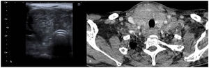 (A) Thyroid ultrasound. Enlarged right thyroid lobe with no clear nodularity. Heterogeneous echogenicity with a "tiger-striped" appearance. Lobe measuring 39mm in length. (B) CT scan of the neck. Generalised enlargement of the thyroid gland with a heterogeneous appearance. Bilateral pathological cervical lymphadenopathy. Decreased tracheal calibre.