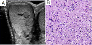 A) Ultrasound of the testis. Right testicle. Solid, rounded, hypoechoic lesion measuring 6 × 6 mm. B) Detail of right testicular tumour. Large cell eosinophilic tumour cells (haematoxylin-eosin, ×200).