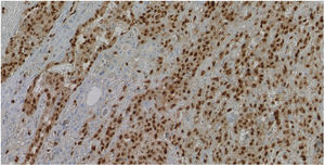 Immunohistochemical staining: ERG. Tumour invasion of thyroid parenchyma and vessels.