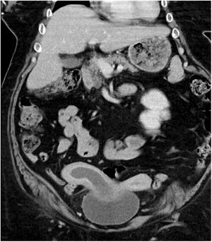 Computed tomography scan: didelphys uterus with right haematocolpos and haematometra.