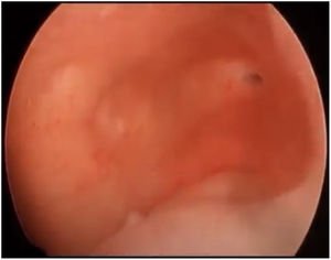 Left normal hemiuterus with a permeable ostium.