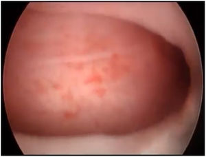 Vaginal septum with obstruction of right hemivagina.