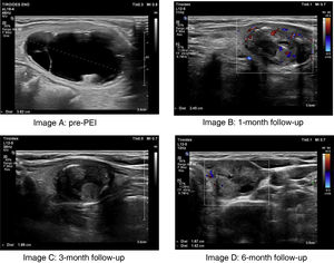 Initial and final ultrasound images of a thyroid nodule treated with percutaneous ethanol injection and ethanol aspiration. A) Pre-PEI cystic thyroid nodule with a maximum diameter of 3.8 cm (nodule volume, 17.10 mL). B) Color Doppler mode ultrasound image at the 1-month follow-up showing minimal peripheral Doppler uptake and a reduction in nodule size with a maximum diameter of 2.4 cm (nodule volume, 2.69 mL, VRR, 84.28%). C) Ultrasound image at the 3-month follow-up showing a reduction in nodule size with a maximum diameter of 1.89 cm (nodule volume, 1.72 mL, VRR, 89.94%). D) Color Doppler mode ultrasound image at the 6-month follolw-up showing persistent minimal peripheral Doppler uptake and almost complete disappearance of the cystic component (final nodule volume, 1.64 mL, VRR, 90.42%).