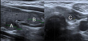 Ultrasound findings at the 18-month follow-up. Left: Longitudinal section of the right thyroid lobe showing one 6.0 mm × 7.3 mm × 7.9 mm hypoechoic nodule A present since the first ultrasound, and one 14.5 mm × 9.4 mm × 6.2 mm rapidly growing isochoic nodule B. Right: Transverse section of the left thyroid lobe showing one new-onset 4.3 mm × 3.9 mm × 4.0 mm hypoechoic nodule C.