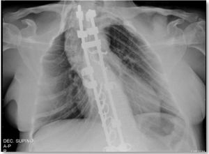 Surgical correction of severe scoliosis.