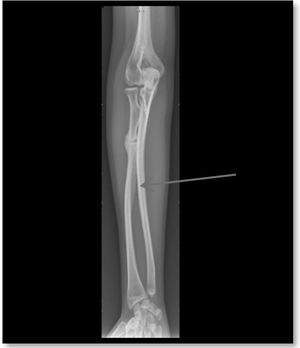 Calcification of the interosseous membrane.