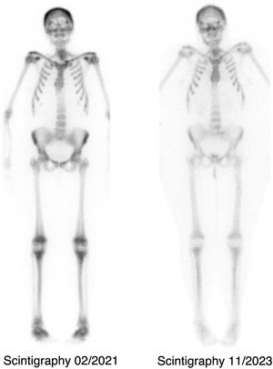 Bone scintigraphy (99mTc-diphosphonates). Metabolic “superscan” pattern with increased activity in calvaria, pelvis, and lower limbs (left). Decreased uptake after 2 years of teriparatide discontinuation and gastroileal bypass reversal (right).