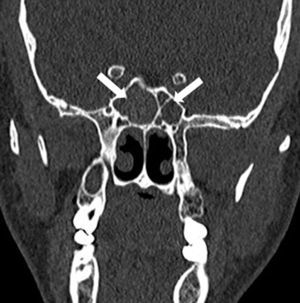 Tomografia computadorizada dos seios paranasais revela esfenoidite bilateral (setas).
