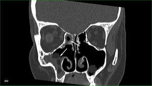 TC dos seios. Polipose de seios maxilar e etmoide (setas brancas) em um paciente após cirurgia prévia do seio, que foi submetido a transplante de células‐tronco hematopoiéticas alogênico devido a mielofibrose primária.