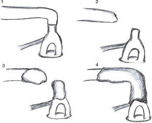 Desenho esquemático dos quatro tempos da reconstrução da cadeia ossicular com cimento resinoso.