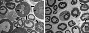 Micrografias eletrônicas de transmissão de axônios mielinizados pós‐lesão. A, No grupo controle, delaminação e deformação foram observadas em bainhas de mielina da maioria dos axônios (setas em negrito), além do aparecimento de corpos ovoides de mielina (setas finas) e citoplasma axonal escurecido (pontas de seta). Muito poucos axônios mielinizados normais (asteriscos) foram observados. B, No grupo experimental, inúmeros axônios normalmente mielinizados são observados (asteriscos). Delaminação e deformação em bainhas de mielina (setas em negrito) e corpos de mielina ovoides (seta fina) são mostradas em apenas alguns axônios mielinizados. Ampliação para ambas as imagens: 4000 ×, imagens representativas são mostradas.