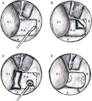 Principais etapas cirúrgicas da técnica de coanoplastia endoscópica de cavidade nasal direita. (C.I., concha inferior; C.M., concha média; S, septo, P.A., placa atrésica; A, assoalho nasal).