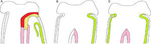 Elevação lateral do retalho mucoperiósteo e exposição da placa atrésica óssea (A). Reposicionamento de retalho de mucosa lateral que cobre a parede nasal lateral após remoção da placa atrésica, em caso de atresia monolateral (B) e bilateral (C), placa atrésica (amarelo); mucosa da face posterior da placa atrésica (vermelho); retalho de mucosa deslocado lateralmente (verde); mucosa septal de cada lado (rosa).