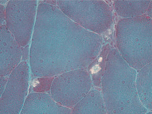 Vacúolos tipo rimmed em biópsia de músculo deltoide (coloração de Gomori modificada, com aumento de 350×).