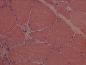Presença de atrofia muscular poligonal e vacúolos do tipo rimmed (coloração de hematosilina‐eosina com aumento de 350×).