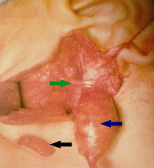 Aspecto intraoperatório: a seta azul indica o trato fistuloso; a verde aponta o tronco do nervo facial esquerdo; e a preta mostra a excisão elíptica da abertura inferior da fístula.